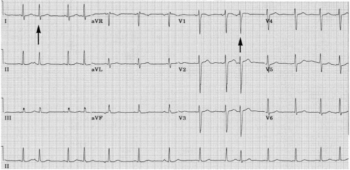 Indian Pacing and Electrophysiology Journal - MacAlpin